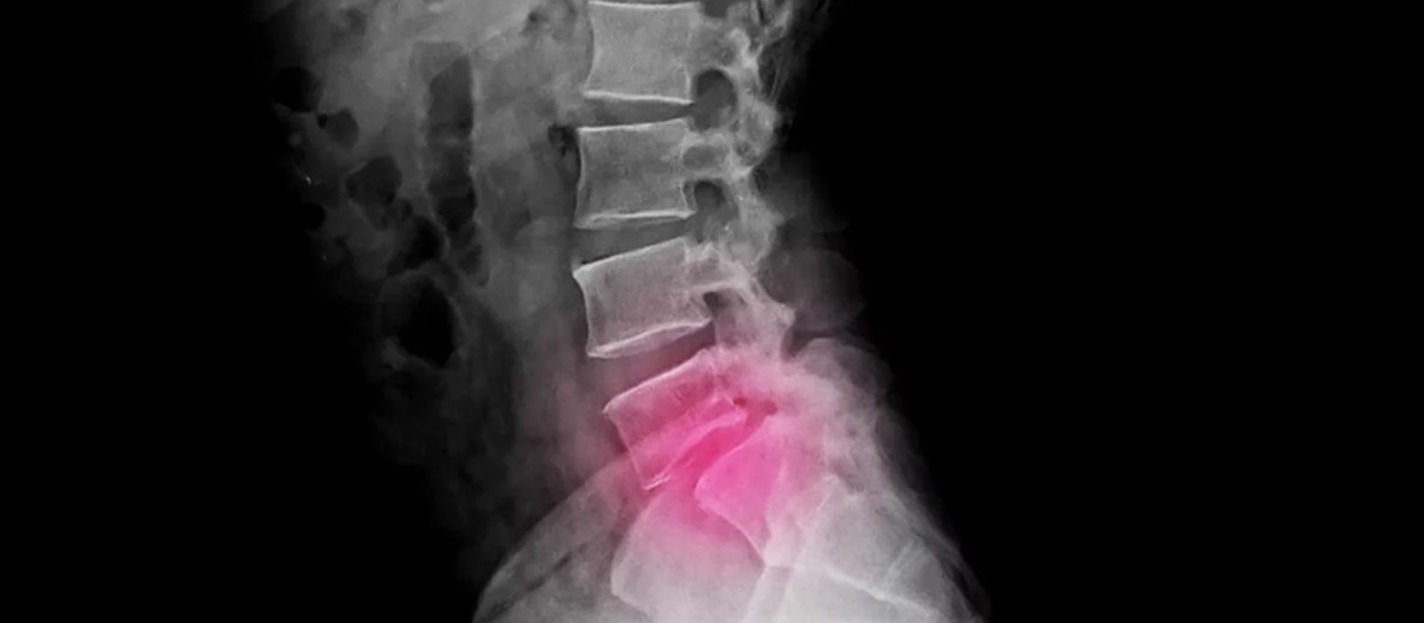 Radiografia con un resultamiento de las cervicales en color