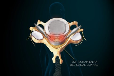 B1b Laminoplastia Cervical - Foto