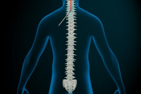 B1c Laminectomia Cervical