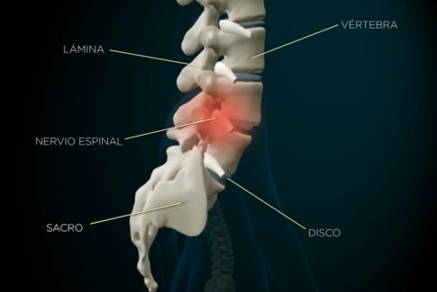 B2a Laminectomía Lumbar