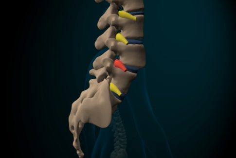 Espondilolistesis