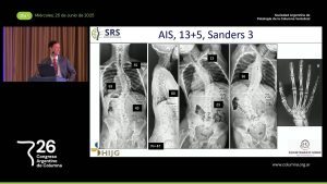 S4d. Presentación de Caso # 2. AVBT vs. Fusión. Las Dos Opciones son Válidas. Dr. André Fernandes Andújar