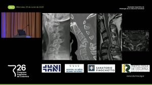 S5c. Presentación de Caso # 1. Cirugía Cervical Anterior. Hematoma Retrofaríngeo con Compresión de Vía Aérea Superior. Dr. Gabriel Rositto