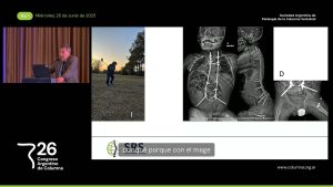 S8d. Presentación de Caso # 2. Escoliosis y Encefalopatía Crónica No Evolutiva (ECNE). Dr. Carlos Tello
