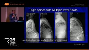 M08a. Osteotomías por Sustracción Pedicular. Dr. Munish Gupta